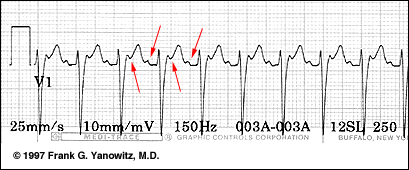 Ecg Learning Center An Introduction To Clinical Electrocardiography