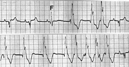 ventricular escape rhythm