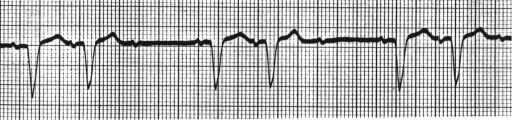 What is the diagnosis of this bigeminal rhythm?