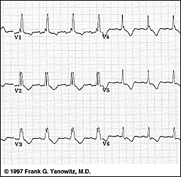 This ECG shows an example of right bundle branch block. What other abnormality is present?